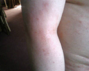 arm scabies day 2