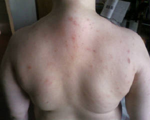 back scabies day 2