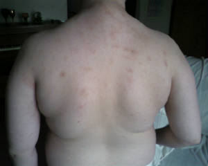 back scabies day 6