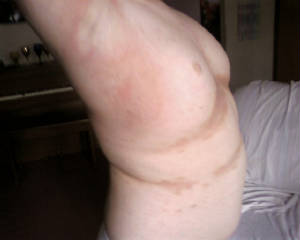 torso scabies day 6