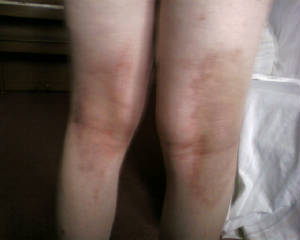 back of knees scabies day 6