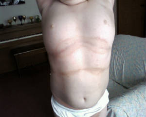 chest scabies day 8