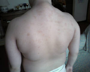 back scabies day 8