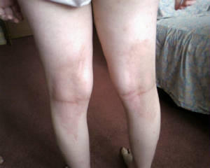 back of knees scabies day 8