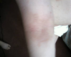 arm scabies day 8