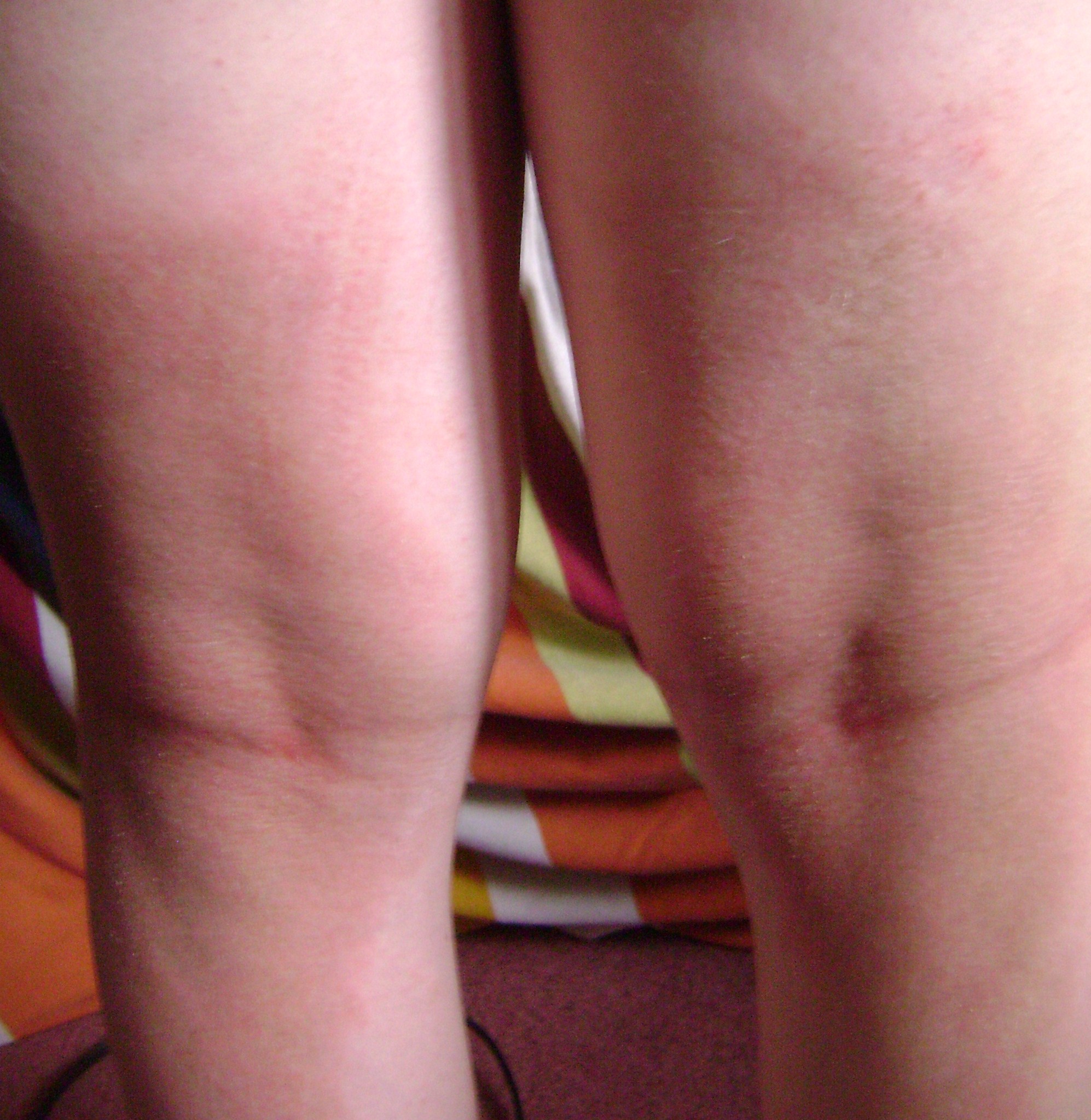 back of knees scabies photo day 12