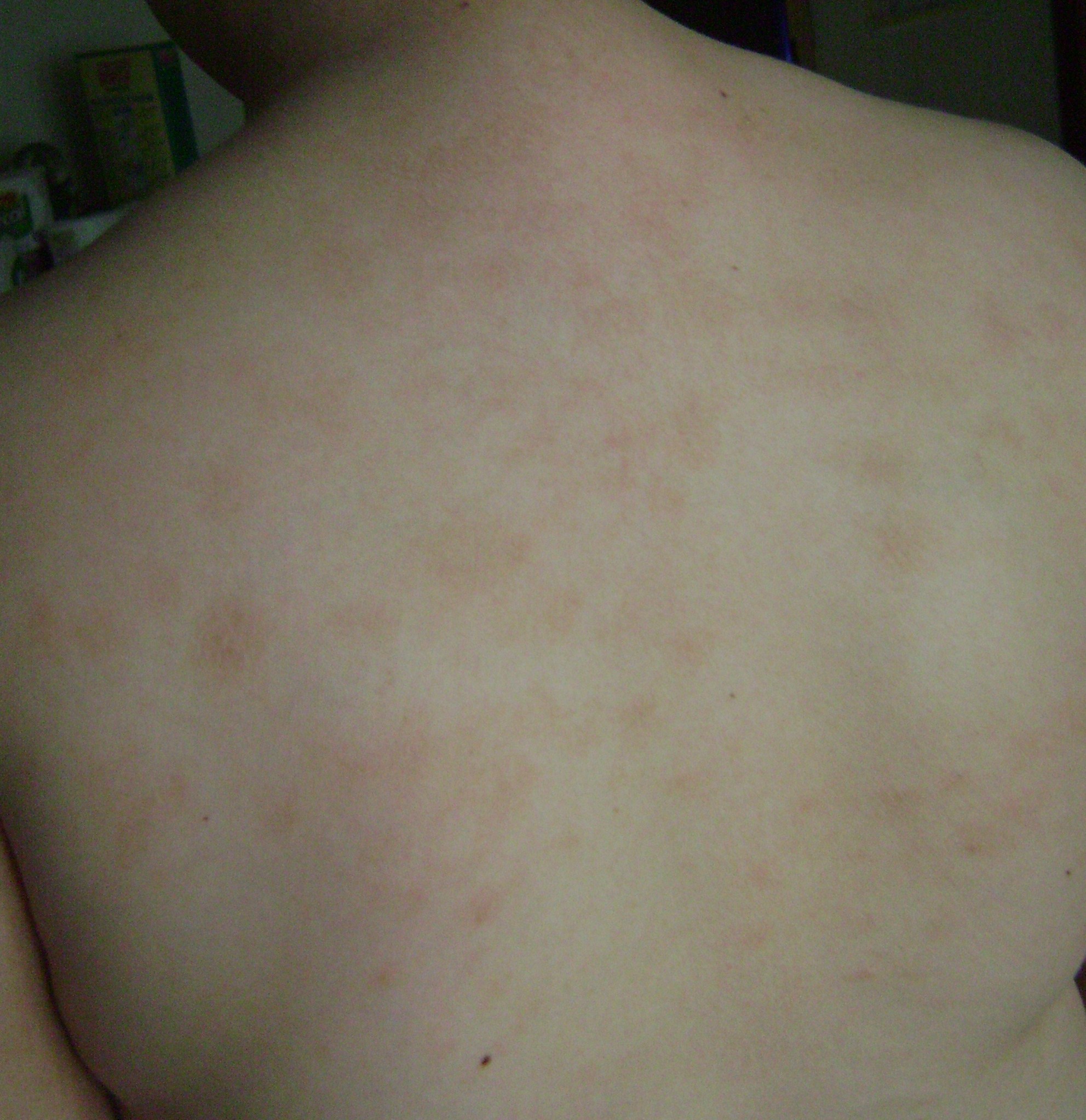 back scabies photo day 12