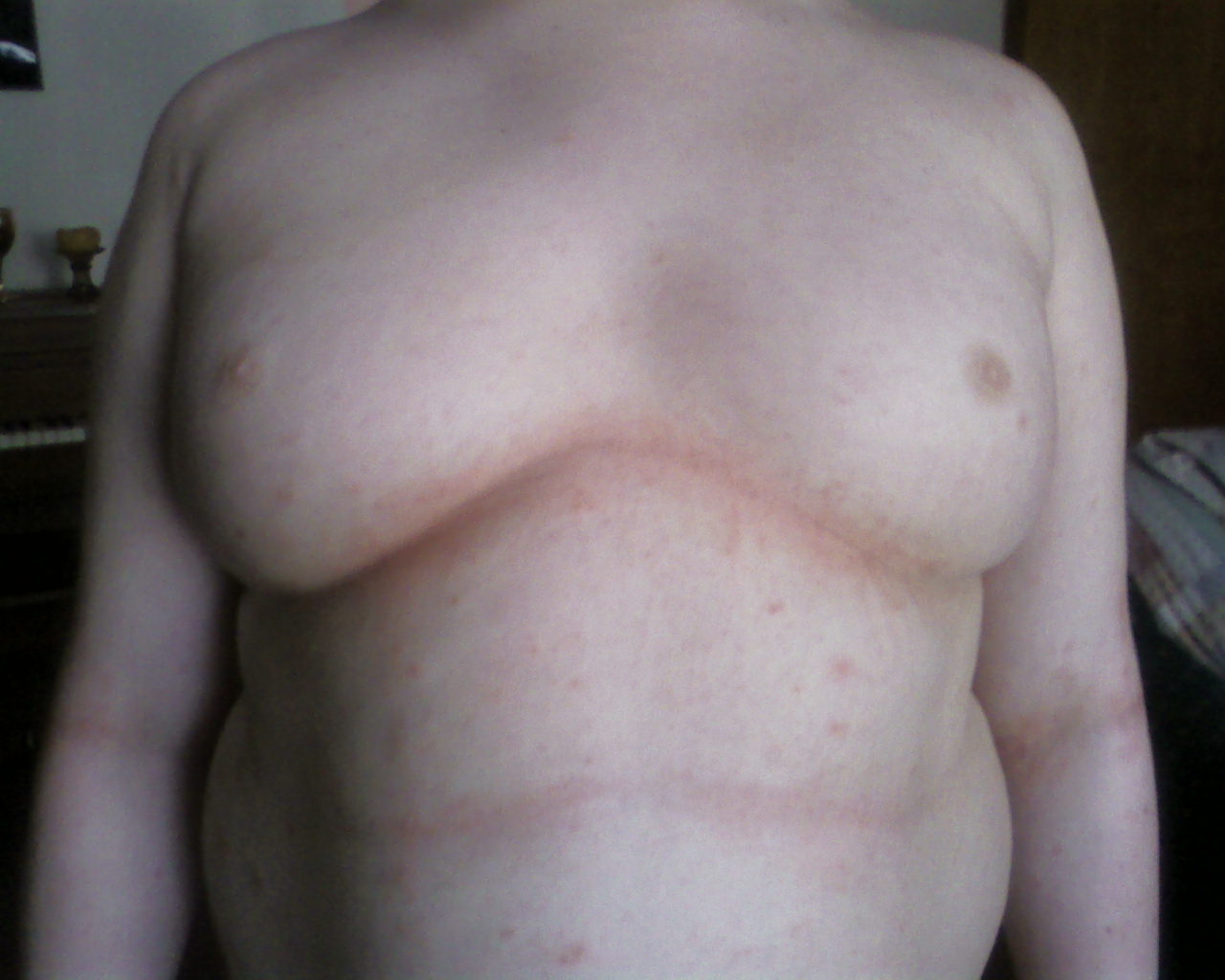 chest scabies day 2