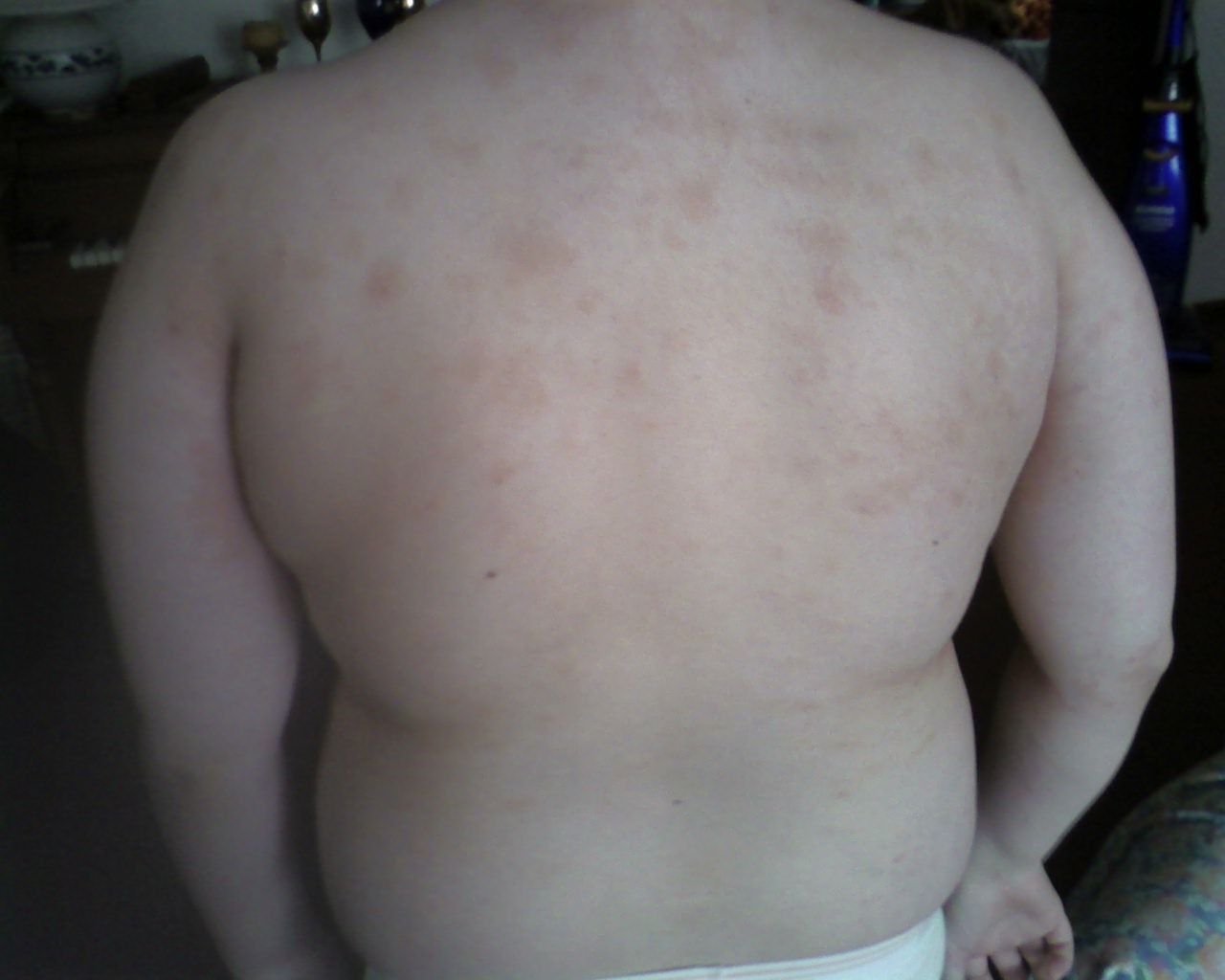 back scabies day 10